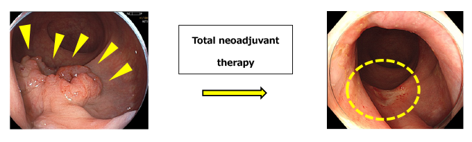 neoadjuvant therapy について