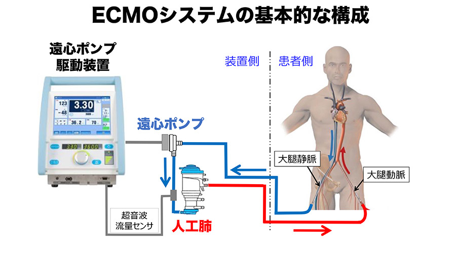 体外式膜型人工肺（ECMO）