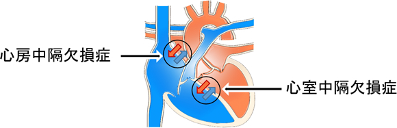先天性心疾患 - 大阪医療センター大阪医療センター