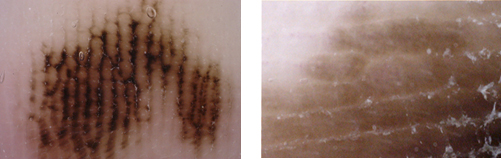 左は色素性母斑（ほくろ）で右が悪性黒色腫（メラノーマ）です