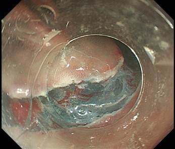 内視鏡的粘膜下層剥離術（ESD）
