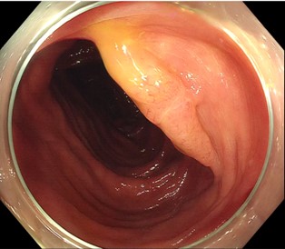 大腸腫瘍に対する浸水下EMRやESD