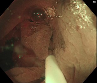 大腸腫瘍に対する浸水下EMRやESD