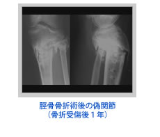 1-1	脛骨骨折術後の偽関節（骨折受傷後１年）