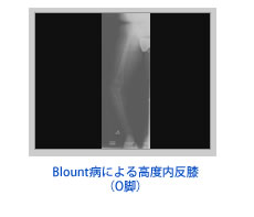 Blount病による高度内反膝（O脚）