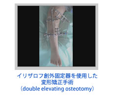 イリザロフ創外固定器を使用した変形矯正手術（double elevating osteotomy）