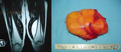 61歳女性、左膝に発生した脂肪腫（左：ＭＲＩ検査、右：切除された腫瘍）