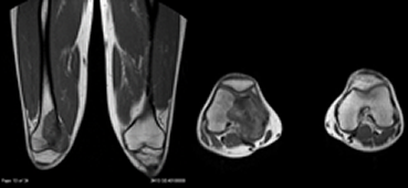 20歳男性、右大腿骨遠位骨肉腫（MRI検査所見）