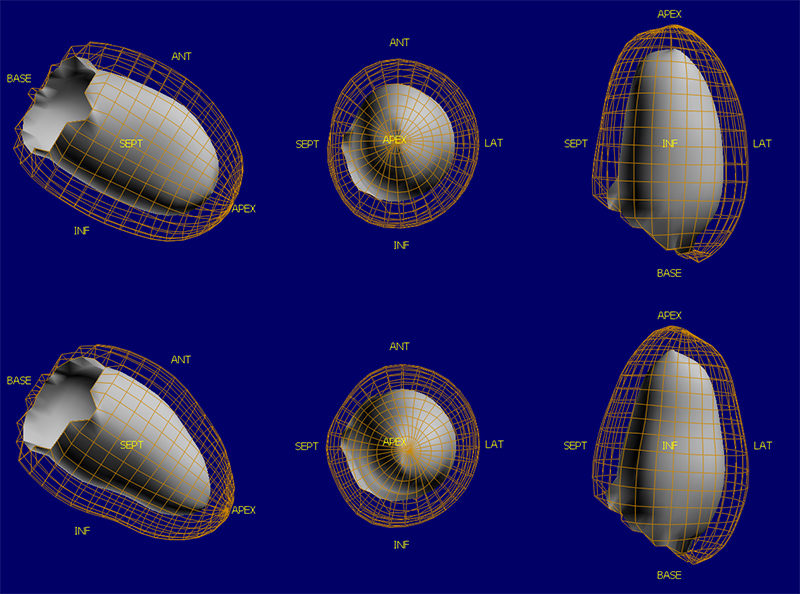 SPECT（断層）画像